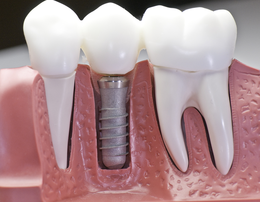 Capped Dental Implant Model
