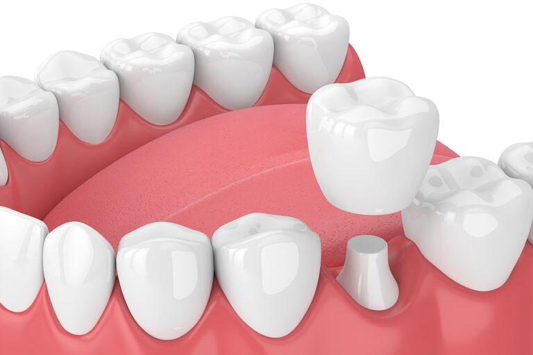 3D Render Of Jaw With Teeth And Dental Crown Restoration