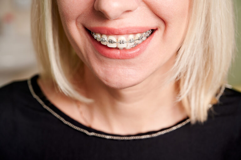 Close Up Of Smiling Patient Showing White Straight Teeth With Or